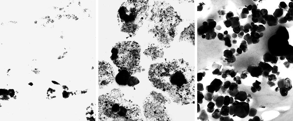 A B E Figure 2. Micrographs from a biopsy specimen of a treated tattoo that changed from flesh color to black on treatment.