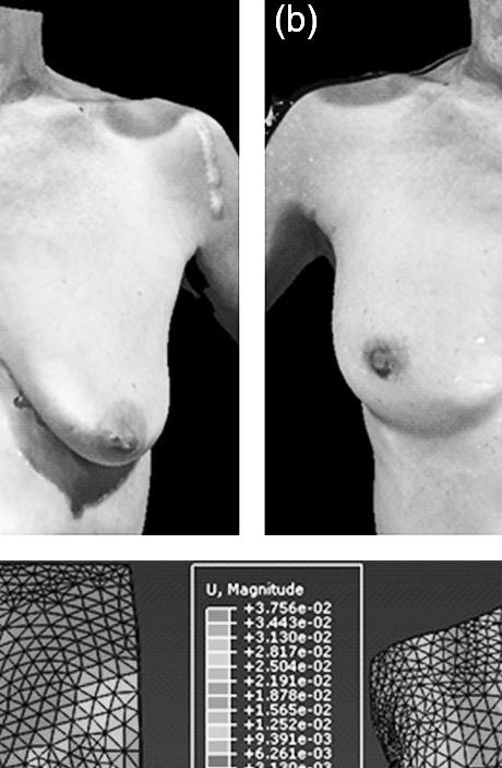 technical research Figure 9: 3D images of breasts with subject (a) standing upright and (b) lying supine.