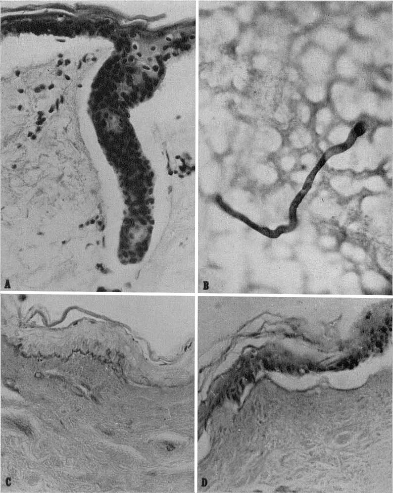 440 THE JOURNAL OF INVESTIGATIVE DERMATOLOGY ;, _It* _t. H A. -i -.- B - 1 j I? FIG. 1. A. Section of epidermis with sweat duct, separating from corium following collagenase treatment. H. & B. XSOO.