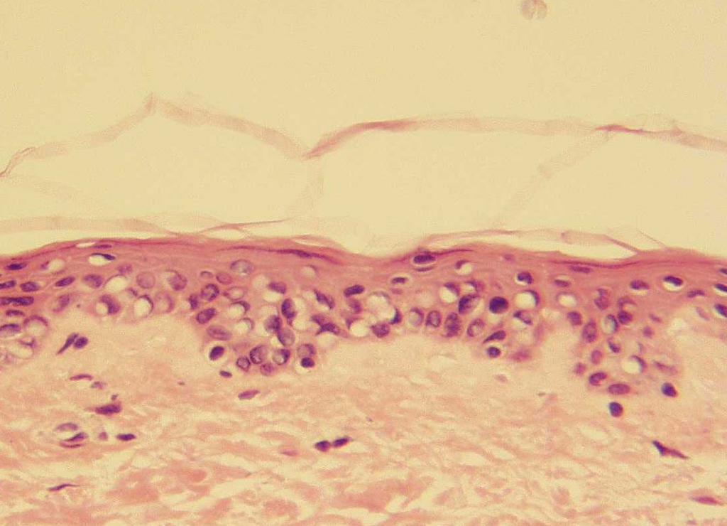 Figure 3. In specific sections, there is epidermal regrowth of keratinocytes.