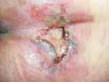 Decubitus (pressure ulcer) Formation of ulcer and necrosis, mostly infected, on the skin or mucous membrane due to chronic topical pressure and resulting 