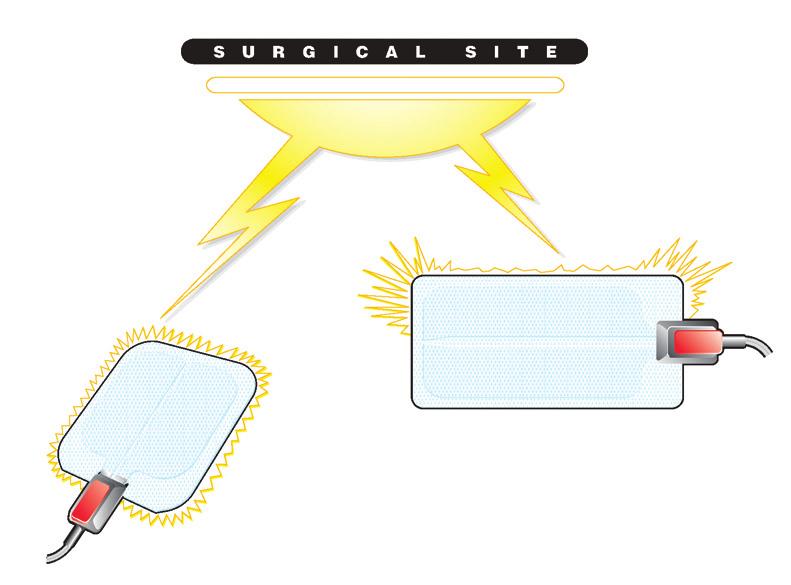 The solution to an old problem... The tendency of electrosurgical current and heat to cluster at the leading edge of a non-capacitive pad has been a long standing industry-wide design problem.