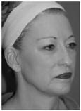 THE McCOLLOUGH FACE LIFTING CLASSIFICATION SYSTEM Face lift is the term commonly used to describe a surgical procedure better known in medical circles as rhytidectomy (removal of loose, wrinkled skin