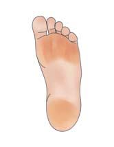 Corns appear on or between toes and calluses are usually found on the balls of the feet and on the heels.