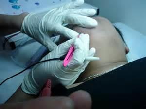 Treatment We insert a sterile needle into the hair follicle along side