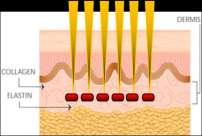 VIVACE Micro-needle electrodes deliver RF energy directly into the dermis Thermal injury