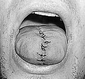 A Modified Man In e Air Force Brent, like many BME members, found tongue splitting appealing, and decided to have it done.