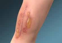 distension of skin under an unyielding adhesive tape or dressing, inappropriate strapping of tape or dressing during