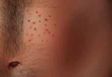 8,10,11 Folliculitis Inflammatory reaction in hair follicle caused by shaving or entrapment of bacteria; appears as small
