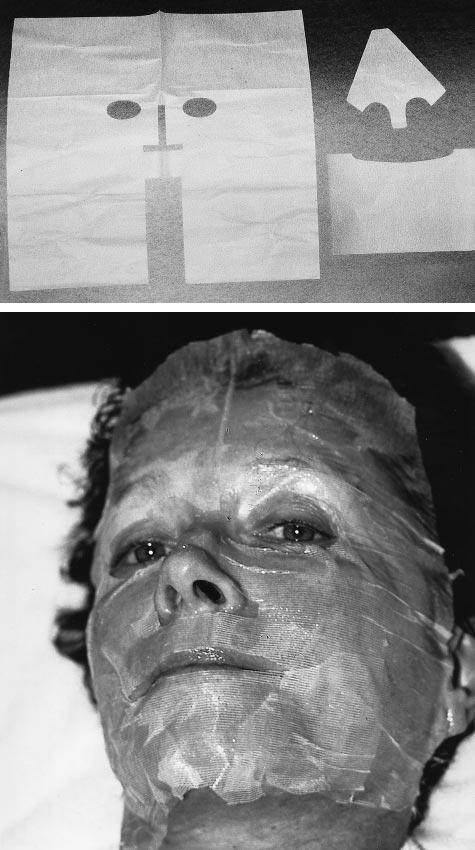 Bottom, Patient after full facial laser resurfacing with application of hydrogel secured with paper tape before placement of a band net dressing.
