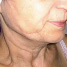 mouth Lifting - skin tightering Neck Dècolleté Before treatment After