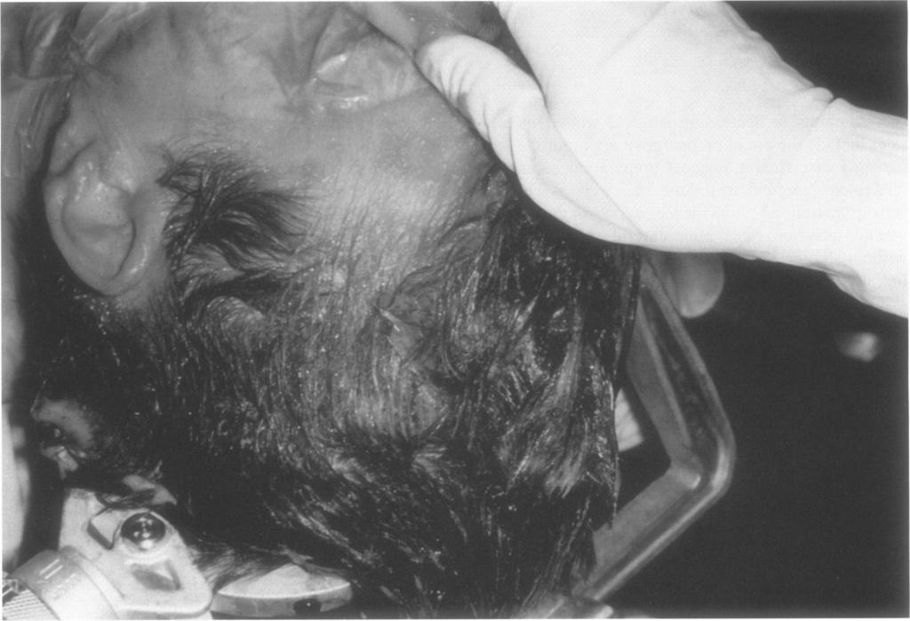 SKULL BASE SURGERY/VOLUME 9, NUMBER 4 1999 METHODS In January of 1997, the senior authors ceased shaving the scalp for most intracranial procedures.
