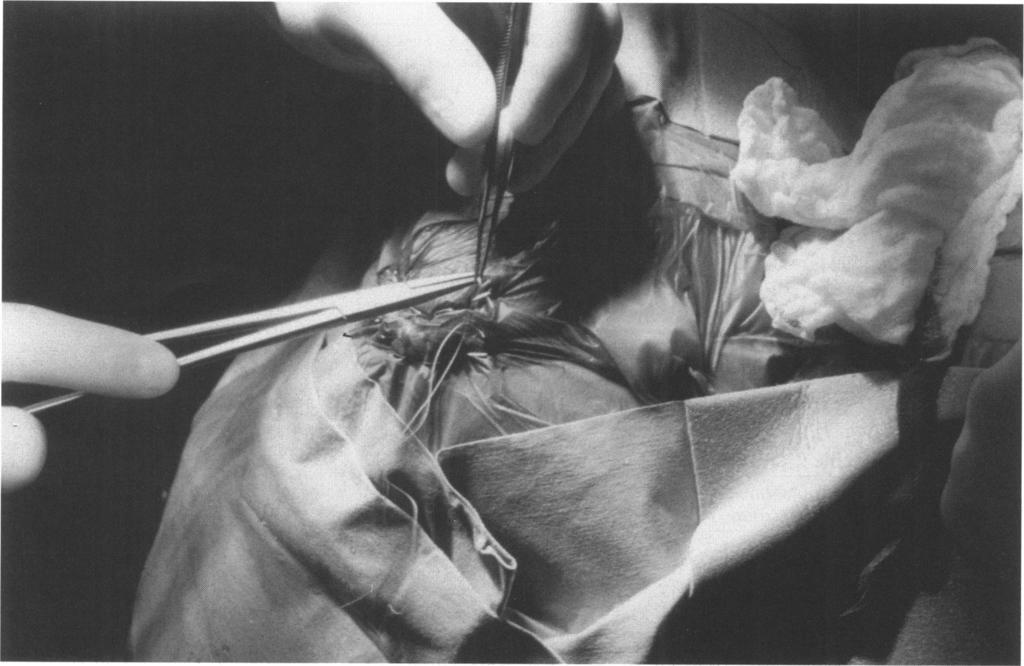SHAVELESS BRAIN SURGERY-HORGAN ET AL RESU LTS Prior to randomization, 45 patients were operated on with shaveless technique beginning in May of 1997.
