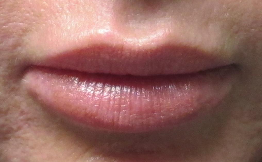 Figure 1: Lips appear more natural after injections Figure 2: Seam in the lower lip Figure 3: Ideal lip ratio on the frontal view the lips too significantly, but it is very possible to swell the