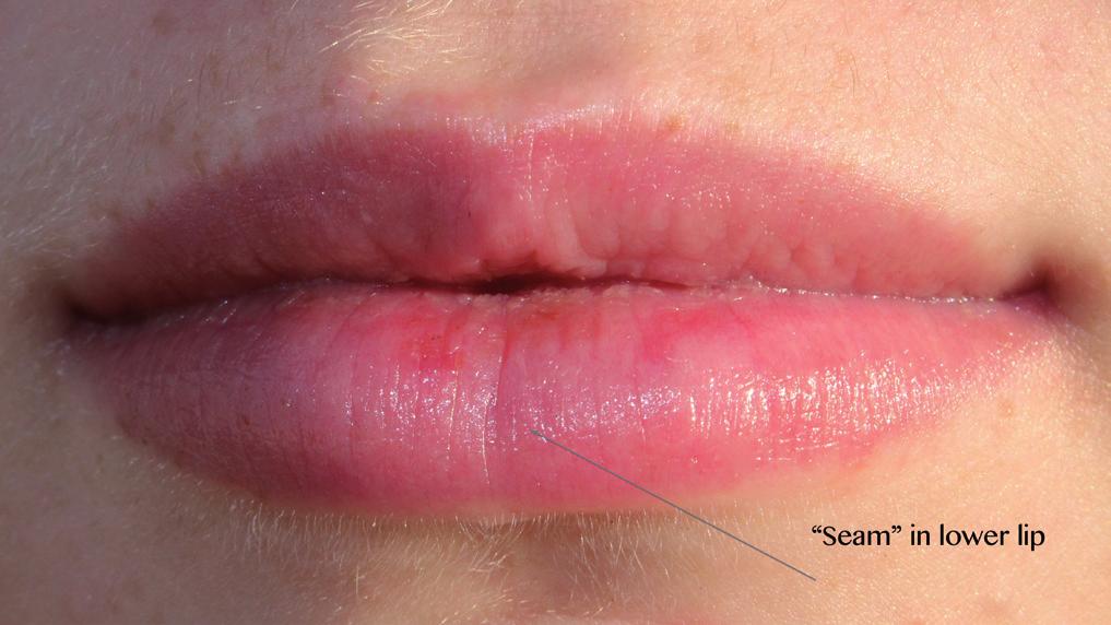 Signs of ageing in the lips During early adulthood, there is a shift in skeletal proportions in the mid-face.