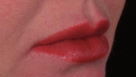 of the lips. The position of the upper lip can even be lifted by effacing the nasolabial folds through elevating the cheeks (Wollina, 2013).