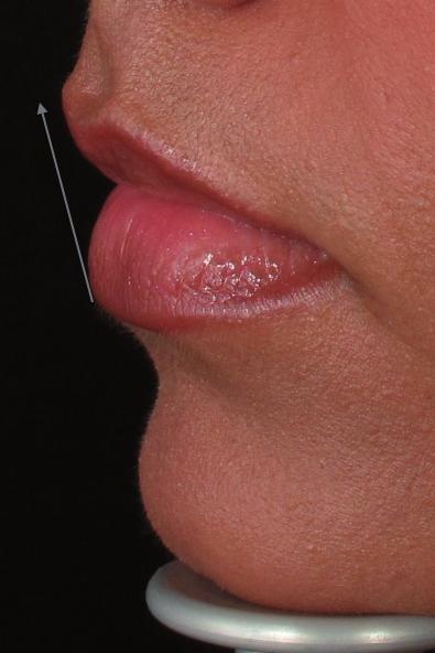 Figure 6: Injection technique for the oral commissures Figure 7: Before and after fixing proportions of upper lip Figure 8: Before and after reshaping upper and lower lip half-inch or 1-inch needle