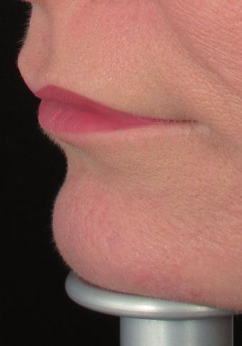 Figure 13: Before and after lip volumisation with 1 and 2 syringes with a smaller amount injected into the middle lower lip. The area should be injected with a total volume of 1 2 ml.