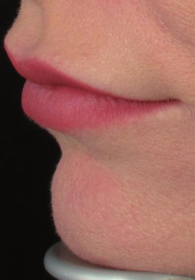 Inject uniformly in vermilion border and sub-vermilion area to maximal fullness. Bolus rods should be injected into the upper and lower lips to exaggerate the curves of this lip (around 0.05 0.1 ml).