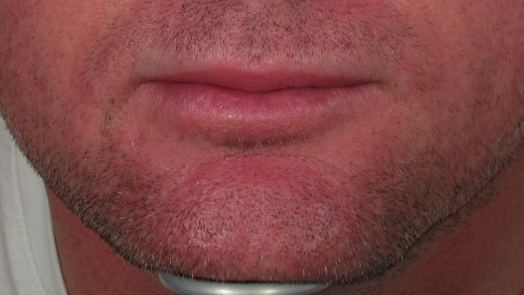 Additional bolus injections in the medial protuberances of the upper and lower lip will give height and curve to upper lip, as well as define two distinct tubercles to the lower lip.