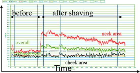 After shaving, increased blood perfusion in the neck area was observed (red line) but not in the cheek area (black line).