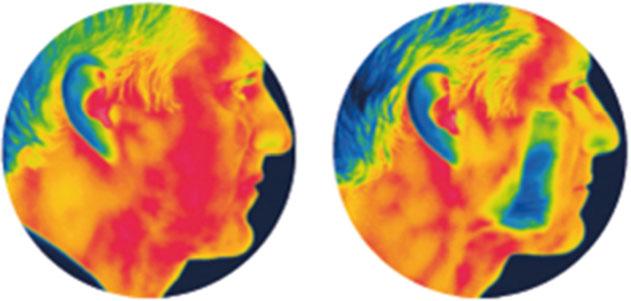 (A) Electric shaver without active cooling Electric shaver with active cooling (A) Subject self-assessment scores *** *** ** * * Figure 5 Thermal imaging of the skin surface after shaving an area of