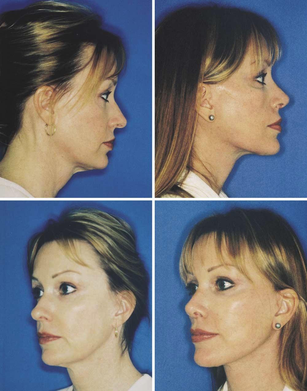 A B C D Figure 7. A, Preoperative photograph of 49-year-old patient before surgery of the midface, jowls, and neck.
