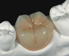 4. Outer Staining Interproximal, cervical and occlusal applications (ridges, fi ssures and cusps) To create an