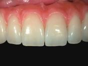 5. Inner Staining Staining of gingiva porcelain Especially for implant supported restorations the stain colors White, Pink, Rose Pink or Pink Orange are recommended for creating individual gum