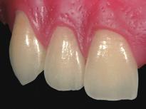 Adjustment of gum color Staining of press ceramic / CAD/CAM crowns Any required color adjustment and natural individualisation after pressing or milling can be achieved with VINTAGE Art Stains.