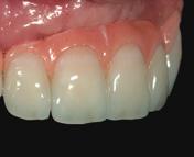 structure Shade application on the incisal area (adjustment of translucency) To intensify the translucency of the incisal area and to adjust the light refl ex ion, Blue, Gray, Violet or Orange
