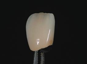 Crowns after pressing After shade adjustment Characterization of artifi cial porcelain teeth VINTAGE Art can be used to individualize conventional porcelain teeth.