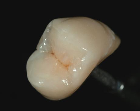 Orange and Brown can be applied thinly to the center of the occlusal