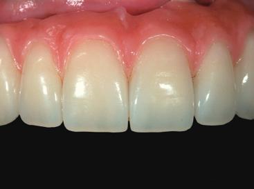 Staining of gingiva porcelain Especially for implant supported restorations the