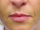 1. Injection of Dermicol-P35 30G into the lips: a) 39-year-old female patient with improvement in the contour of the upper and lower lips