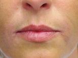 7 ml; b) 44-year-old female patient with improvement in upper lip volume (also nasolabial and marionette lines) 2 weeks after injection of 0.