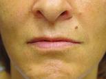 8 ml of and d) 41-year-old female patient with improvement in upper and lower lip volume and contour 25 weeks after injection of 0.