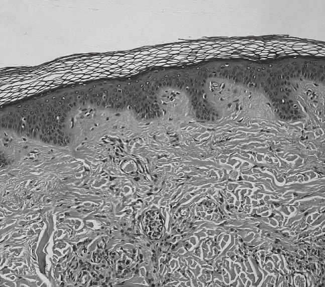 Stained slide of normal epidermis and dermis, with a benign intradermal nevus and grafted onto a hairless mouse, and they generated new follicles that cycled normally.