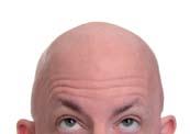 Alopecia Hair loss, or baldness whether the hair will grow back or not depends on the cause of the hair loss. Club cutting The most commonly used technique to remove length.