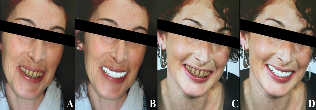 Figure 1. Simulation of the treatment on the same patient (A) by different specialists. Traditional dental treatment without HA fillers (B).