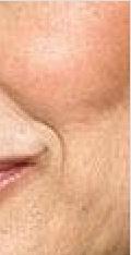 Early photo aging (mild pigmentary changes, no keratosis); minimal acne scarring; need minimal or no make-up. Type II Wrinkles in motion. Patient age 30-40.