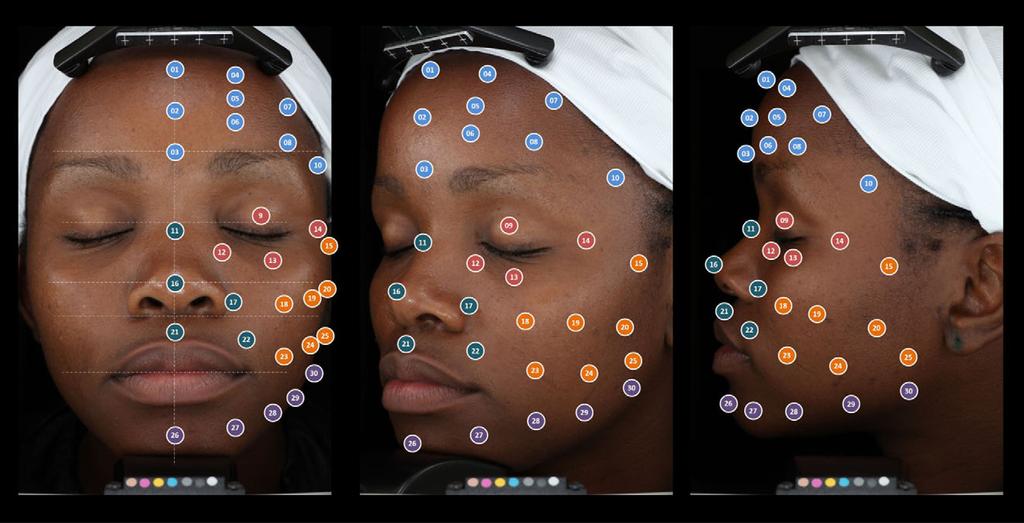 Figure 1 Anterior, oblique and lateral Visia-CR images of 30 pre-defined facial sites measured, demonstrated on one selected subject.