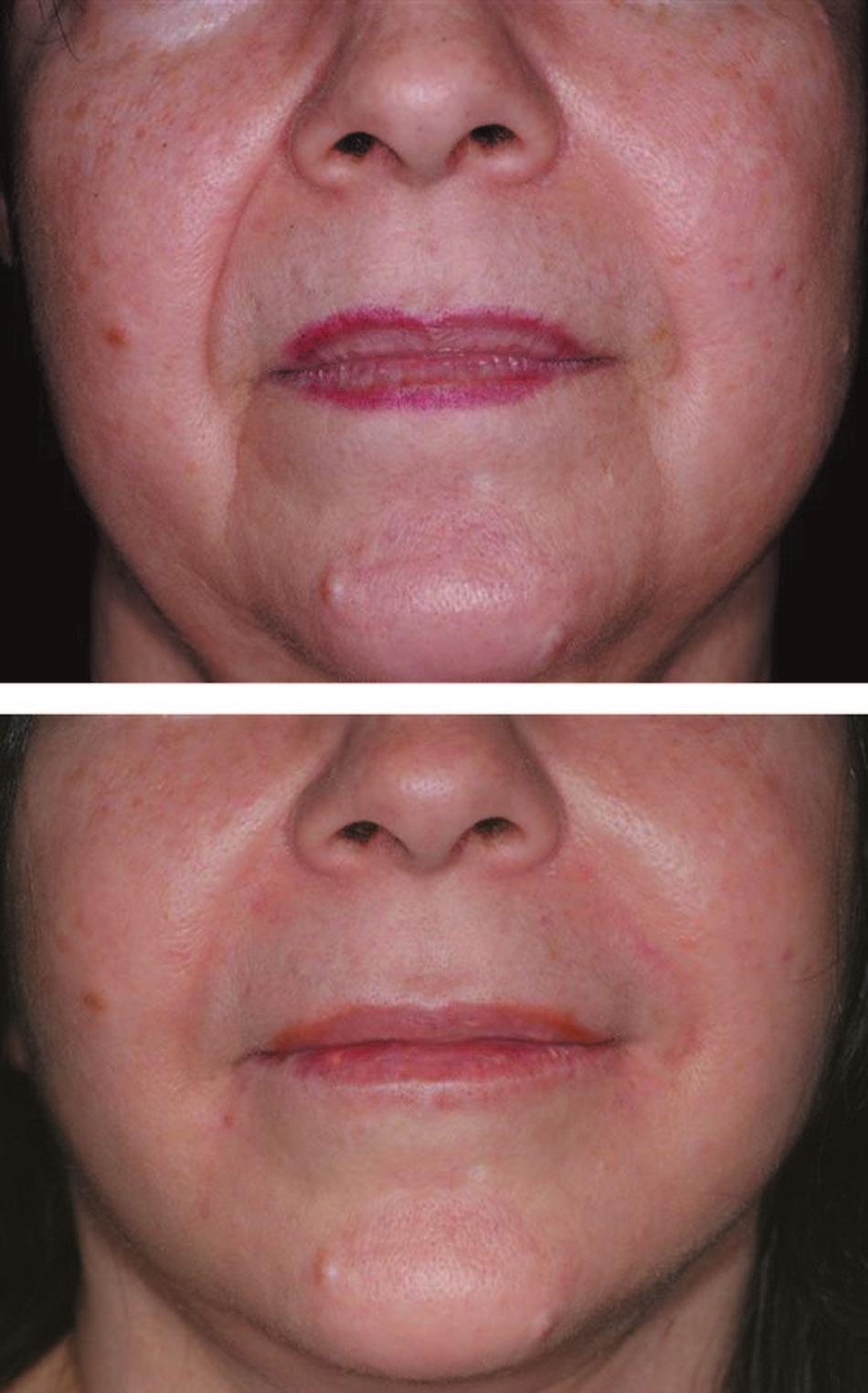 Plastic and Reconstructive Surgery November Supplement 2007 Fig. 8. A 73-year-old woman before and 3 months after injection of 3.