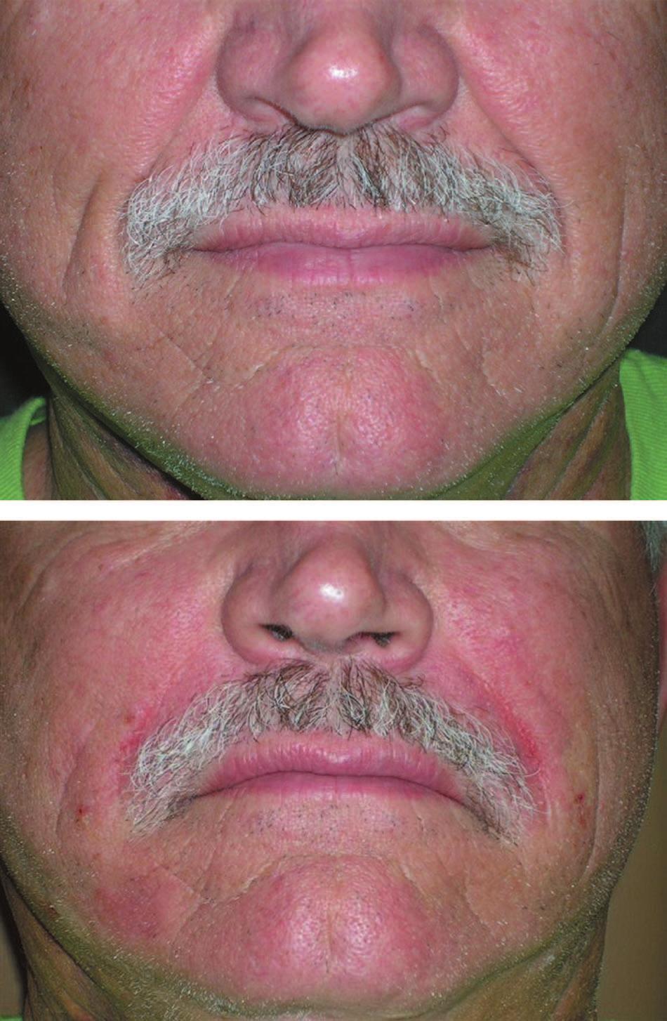 Volume 120, Number 6S Calcium Hydroxylapatite (Radiesse) Fig. 6. A 63-year-old man before and immediately after injection of 2.2 ml of calcium hydroxylapatite for correction of nasolabial folds and 0.