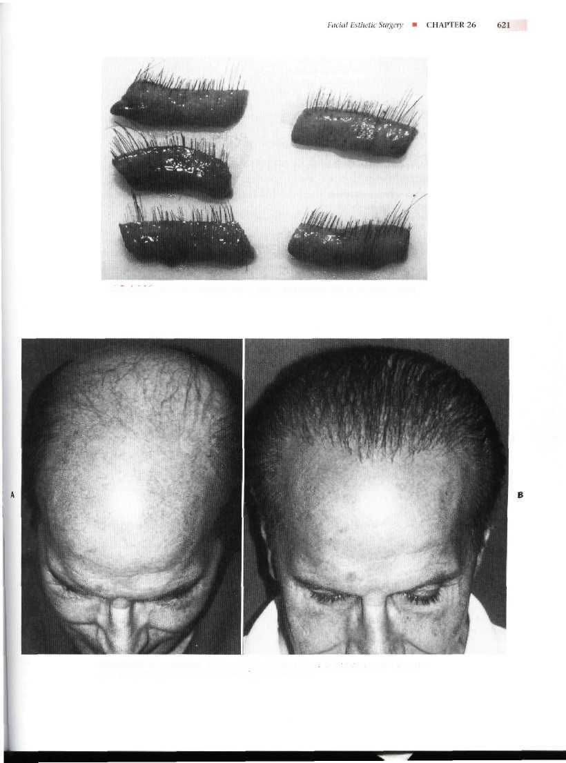FIG. 26-3 1 Harvested minigrafts from a strip of hair-bearing scalp in the vertex region. FlG. 26-32 Hair restoration.