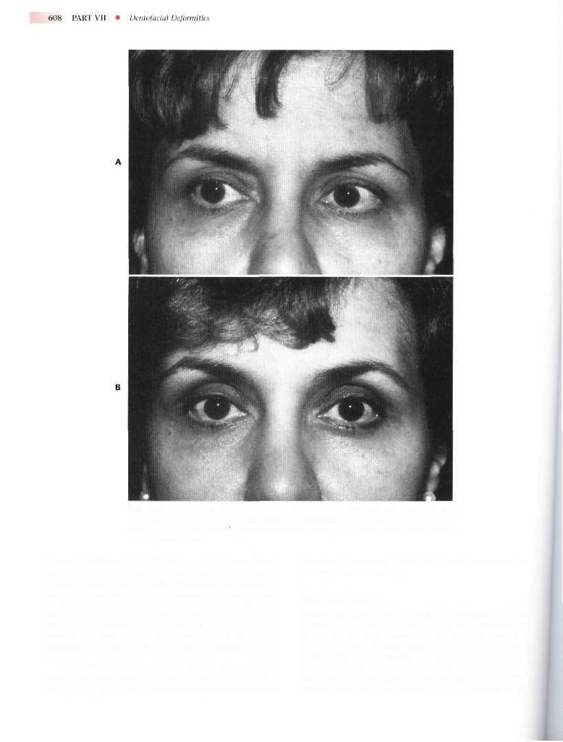 FIG. 26-7 A, PreoperaHve frontal view of a middle-aged female with brow ptosis and mild dermatochalasis ol her upper lids.