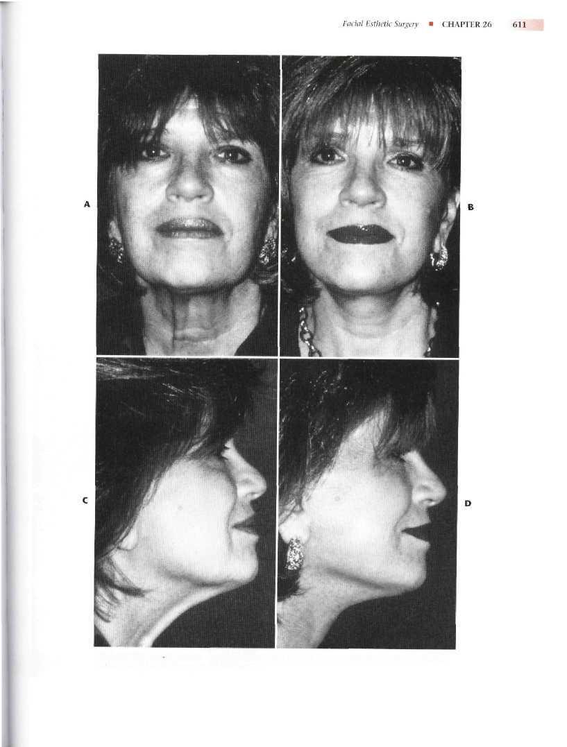 FIG. 26-14 Facelift surgery. A, Preoperative frontal view.