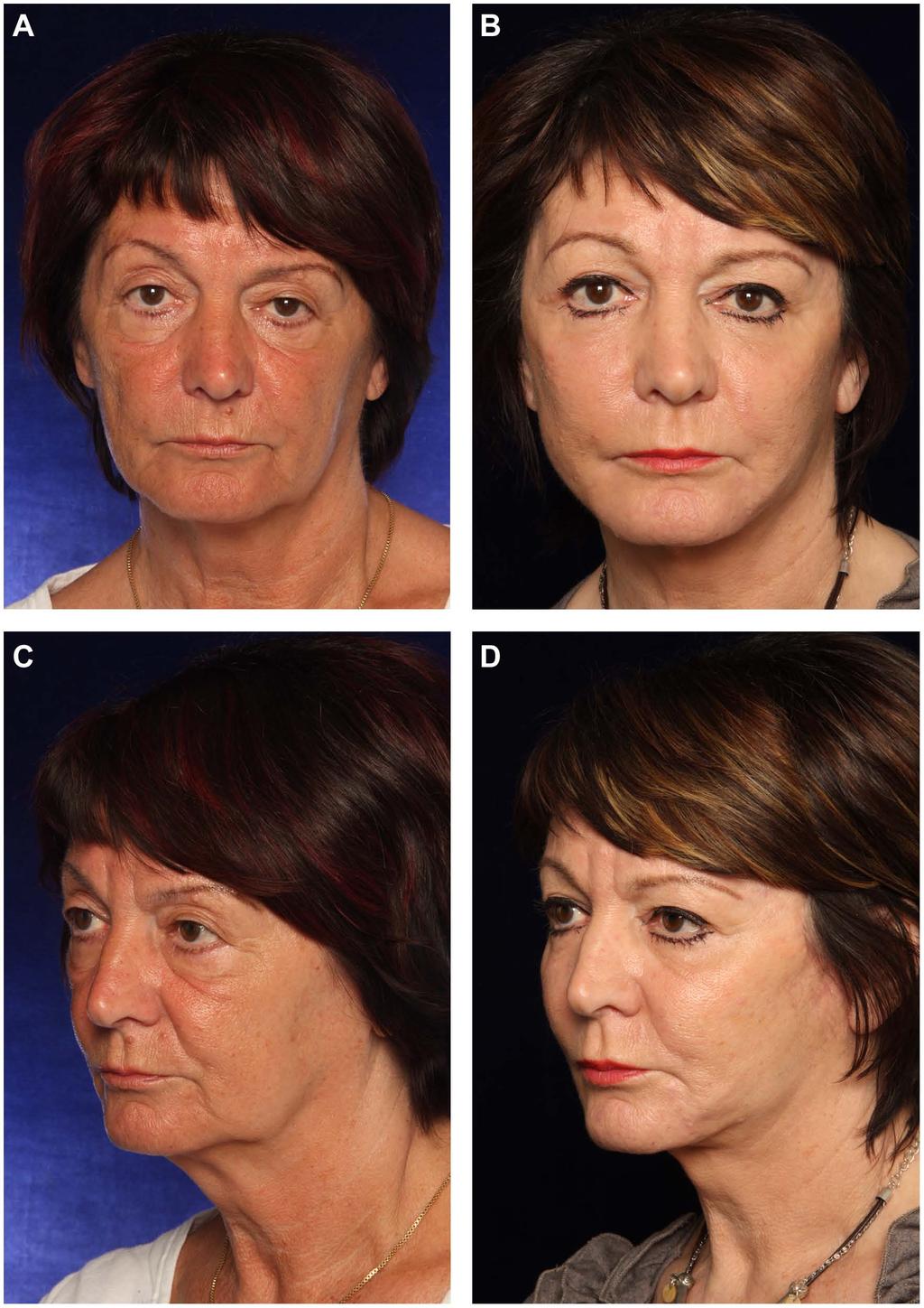 350 Aesthetic Surgery Journal 33(3) Figure 10. (A, C) This 60-year-old woman presented for total facial rejuvenation.