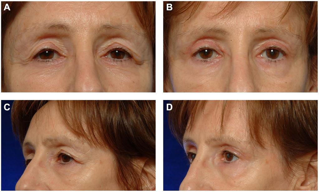 342 Aesthetic Surgery Journal 33(3) Figure 1. (A, C) This 54-year-old woman presented for upper and lower blepharoplasty.