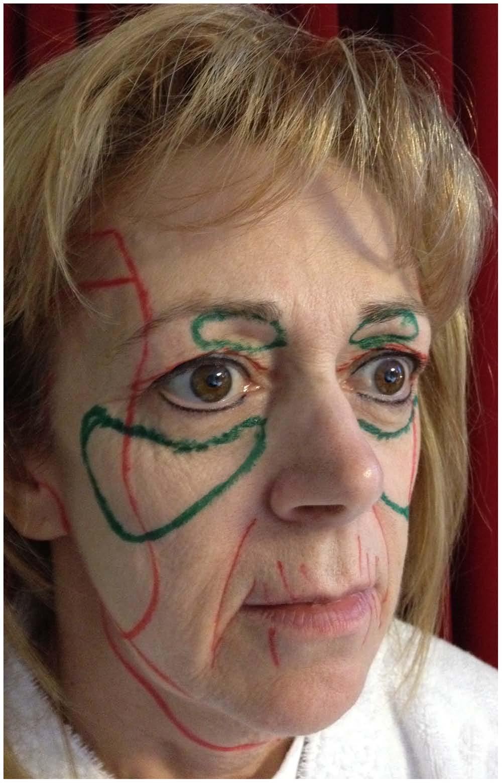 344 Aesthetic Surgery Journal 33(3) Figure 4. Typical markings for an augmentation blepharoplasty procedure. The periorbital areas to be augmented are marked in green. In the upper eyelid, 0.5 to 2.